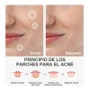 180pzs Parches Pegatinas Para Acné Absorbentes Pimple Patch