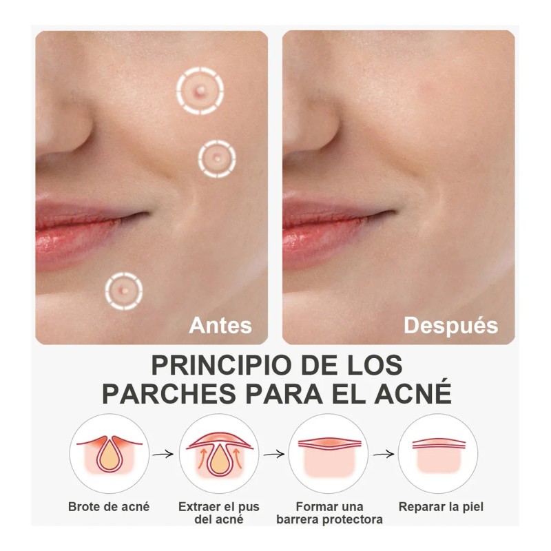 180pzs Parches Pegatinas Para Acné Absorbentes Pimple Patch