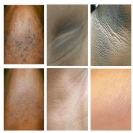 Nutrition Phirst Dark Skin Whitening Dark spot  Brightening Bleaching Face body Cream 2 pack