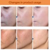 Gesichtsserum,Peeling-Lösung,Gesicht Exfoliant,Schönheitsfehlern Reduziert Gegen Pickel & Mitesser, Große Poren,2Pcs