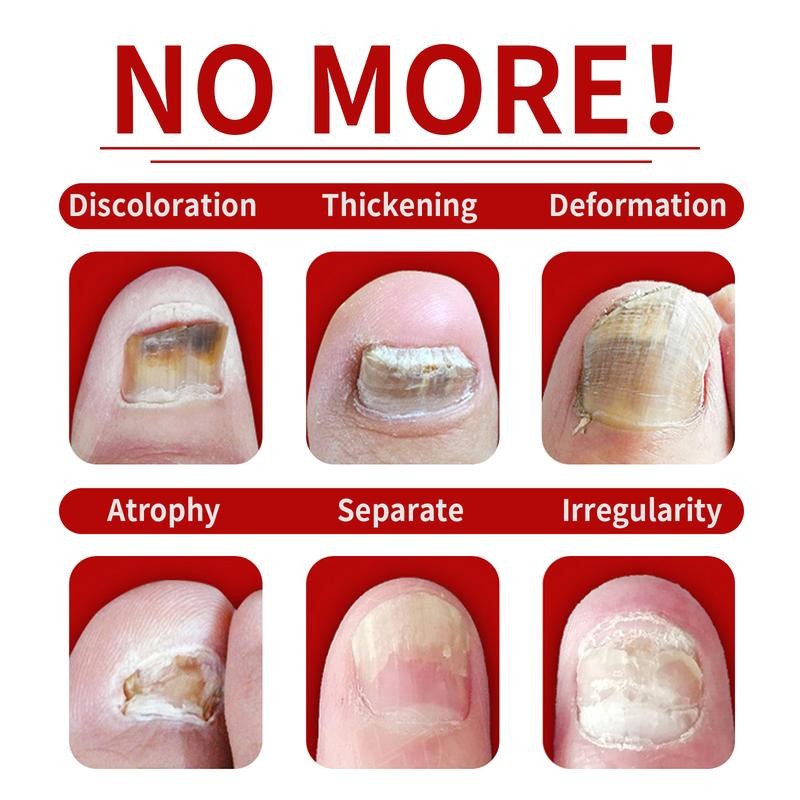 JAYSUING Ginger Nail Treatment-Vitamin E & Plant Extracts for Repairing