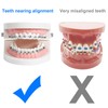 Comfort Cover for Braces, Lip Protector Mouth Guard Lip Cushion