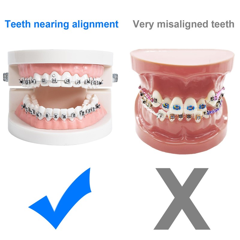 Comfort Cover for Braces, Lip Protector Mouth Guard Lip Cushion