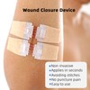 Emergency Wound Closure Strips, Butterfly Band-Aids