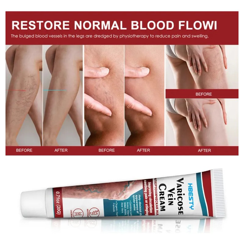 Crema Varicoso Contra Varices De 3 Piezas Para Fortalecer La