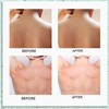 CIZ Body Acne Spray, Herbal Formula, 2%Salicylic Acid, Tea Tree