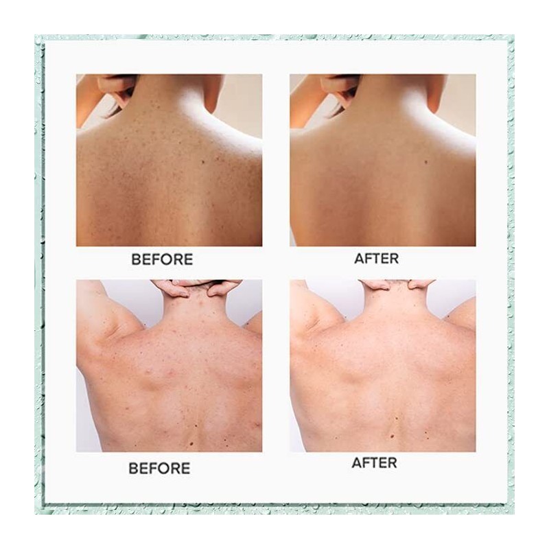CIZ Body Acne Spray, Herbal Formula, 2%Salicylic Acid, Tea Tree