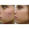 Pasion Organica MX Jabon Raiz Tepezcohuite Puro Cicatrices Acne Manchas