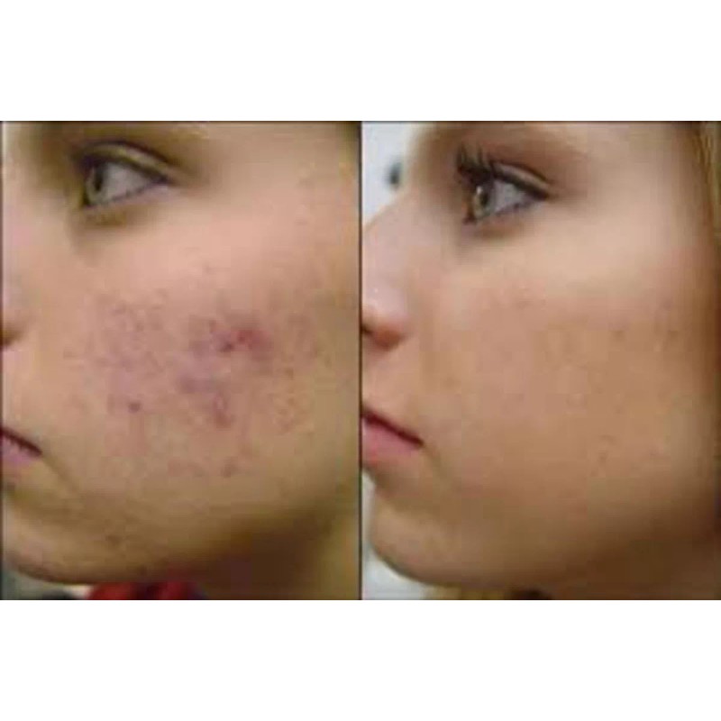 Pasion Organica MX Jabon Raiz Tepezcohuite Puro Cicatrices Acne Manchas