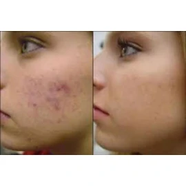 Pasion Organica MX Jabon Raiz Tepezcohuite Puro Cicatrices Acne Manchas Organic