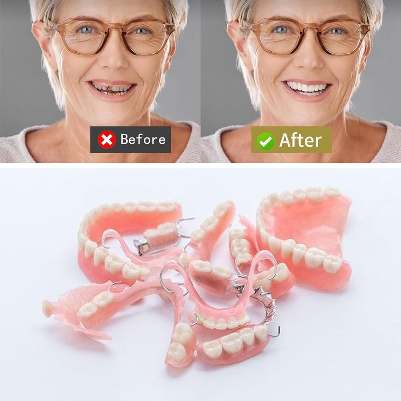 Gum Material - for Repairing Missing Teeth and Smile Improvement.