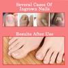 Ingrown Toenail & Cuticle Support Oil – Helps Maintain Nail