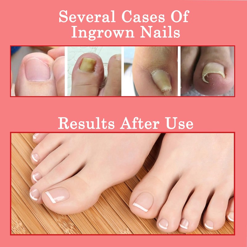 Ingrown Toenail & Cuticle Support Oil – Helps Maintain Nail