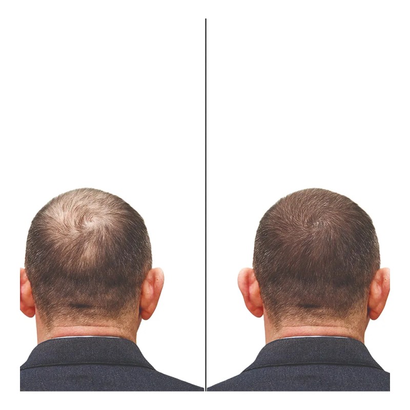 Dutasterida 0.5 Mg 30 Tabletas Dutandro