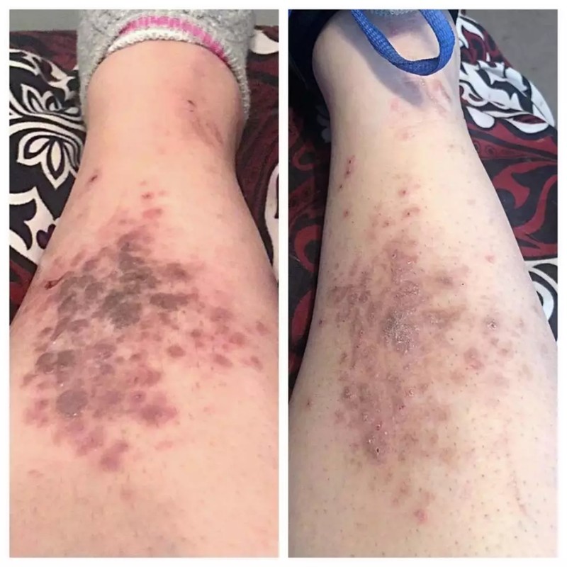 LichensEze 16 Oz All Natural Relief, For Lichen Planus No