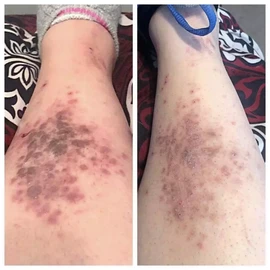 LichensEze 16 Oz All Natural Relief, For Lichen Planus No Chemicals