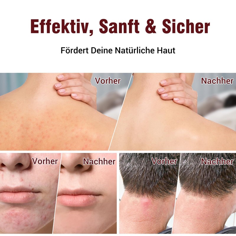 Follikulitis-Creme 100g - Soforthilfe bei seborrhoischem Ekzem, Aknederm & Juckreiz