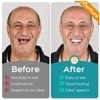 Dentures DIY Kit, Create Your Perfect Smile at Home: DIY