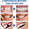 Fix Broken or Missing Teeth with Temporary Tooth Filling Restoration