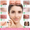 Fangze Blackhead Remover Tool Kit - 6pcs Pimple Popper Tool