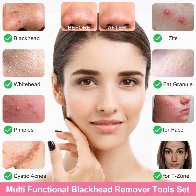 Fangze Blackhead Remover Tool Kit - 6pcs Pimple Popper Tool