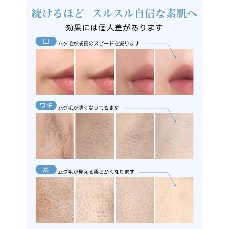 Epilator Salon Grade IPL Light Epilator, Large Epilator, 990,000 Rounds