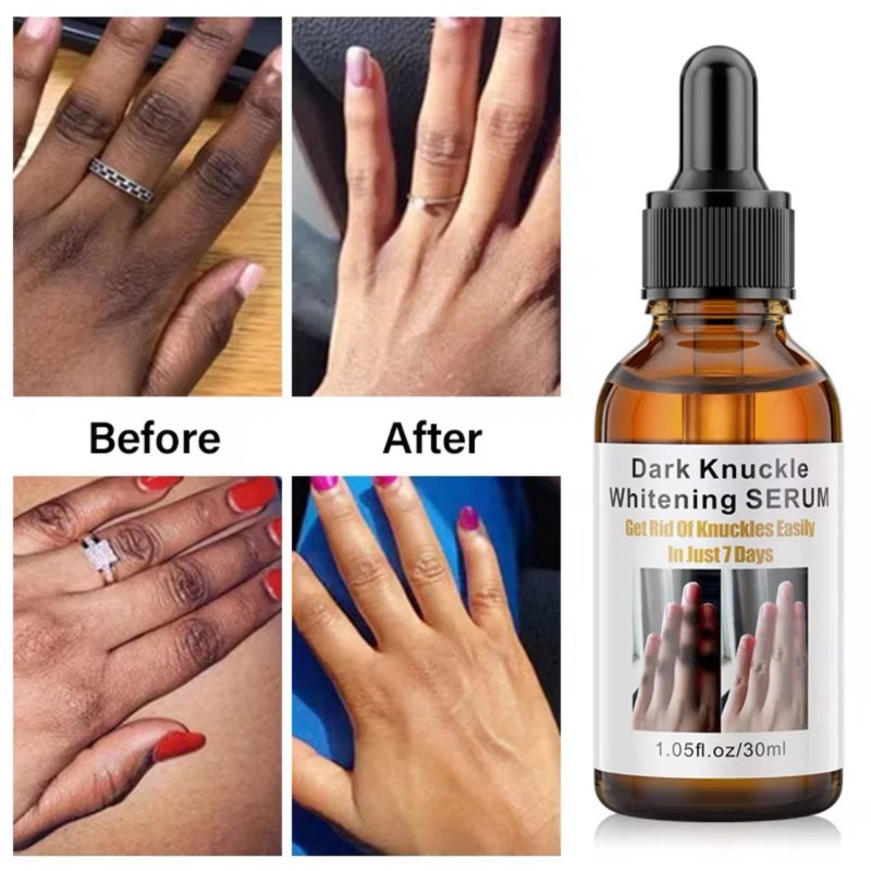 Aromixe 2 Pack Whitening Serum 30ml for Knuckles, Feet, Elbows,