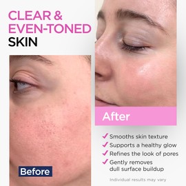 Ember Cloud Glycolic Acid Serum for Face 15% - Extra Large Size (2 Oz) - Advanced Formula to Support Skin Radiance, Addressing Uneven Tone & Fine Lines