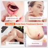 Red Light Cold Sore, Cold Sore Treatment Device, Red Light