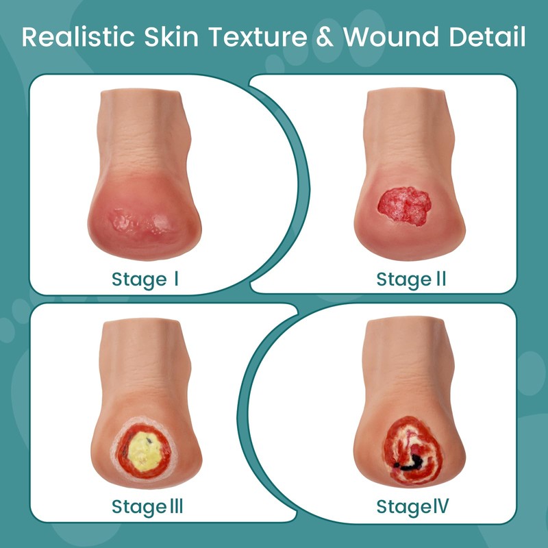 MedEduQuest Heel Pressure Injury Stages Model, Ulcer Demonstration Model