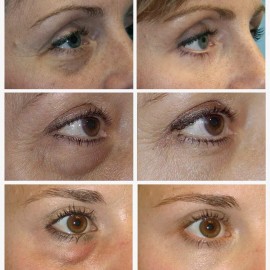 Lanbena Parches Lanbena Mascarilla De Ojos Ácido Hialurónico Full