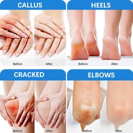 Urea Cream 60 Percent for Feet,Urea Foot Cream for Cracked Heels and Dry Skin - Cracked Heel Cream Urea Moisturiser Plus 2% Salicylic Acid - Foot Cream for Calluses and Hard Skin - Urea Moisturiser