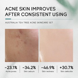 5Pcs Hautpflege-Set, Teebaum-Hautpflege-Kit für Frauen Mädchen, tägliche Hautpflege-Kits mit Gesichtsreiniger, Toner, Essenz, Essenz, Augencreme und Gesichtscreme