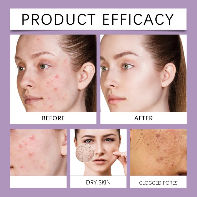 Soothing Cream Moisturizing Improves Lightens Blackheads An