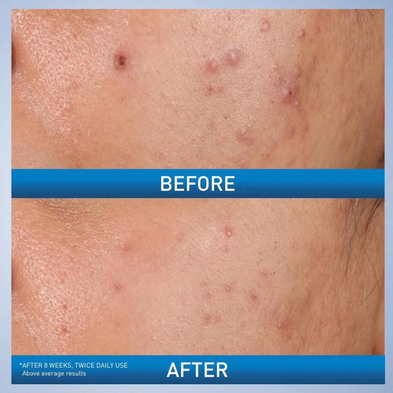 Cerave Gel Para El Control Del Acné, Tratamiento Con Ácido