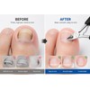 Ingrown Toenail Clippers for Thick & Hard Nails – Precision