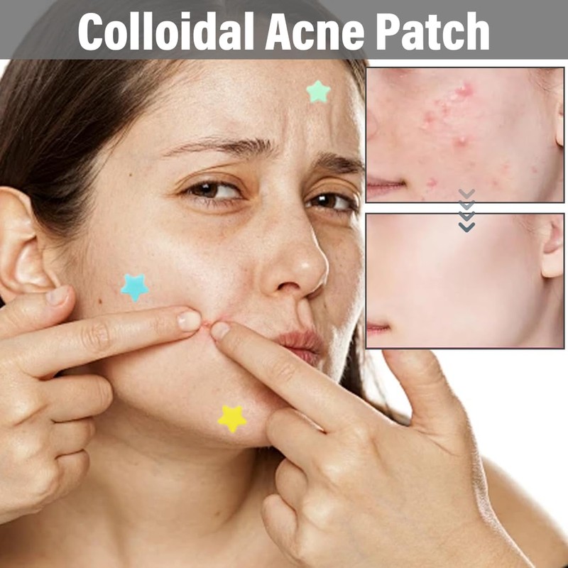 Pimple Patch, 357 Counts Pimple Patch Stars Pimple Patches, Hydrocolloid
