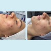 Salicylic Acid 20% Gel Peel - Enhanced with Tea Tree