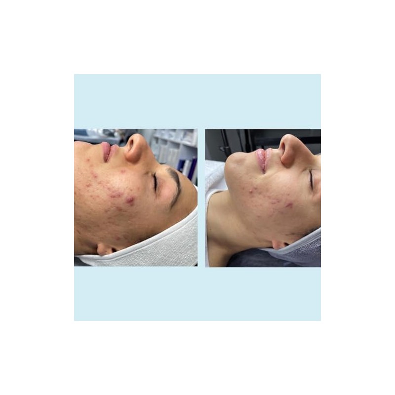 Salicylic Acid 20% Gel Peel - Enhanced with Tea Tree
