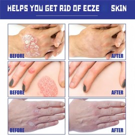 Anti Itch Cr/eam,Relieve Itching Cream for Skin,Anti Fungal Cream,Quickly Relieve Itching,Soothes Itching,Helps Soothe Skin Discomfort,Suitable for Sensitive Skin,Keep Skin Health,Moisturize