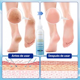 Extra Strength Foot Callus Remover Gel, Exfoliación de Piel Muerta,Foot Callus Remover Gel, Feet Scrubber, Adecuado para Piel Agrietada y Áspera de Los Pies, Cuidado de Los Pies En Casa (6 Oz)