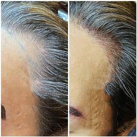 Voloria Frontal Hairpiece for Women Human Hair Extensions Forehead Hairline PU Skin Toppers Hair Replacement Toupee (1.18x6.69 Inch, 1B Mixed 20% Grey Hair