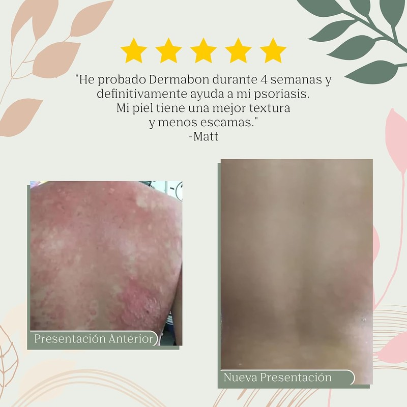 Jabón de Alquitrán para Psoriasis y Eccema, Barra Medicada 2.50