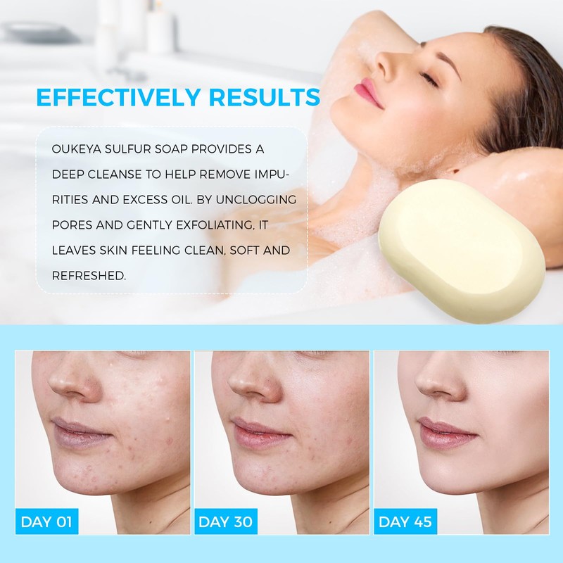 Sulfur Soap for Face with 10% Sulfur, 2% Salicylic Acid,