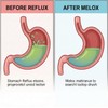 Melox for Heartburn Relief