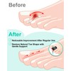 snqqmtt 2Pcs Hammer Toe Straightener with Removable Aluminum Plate and