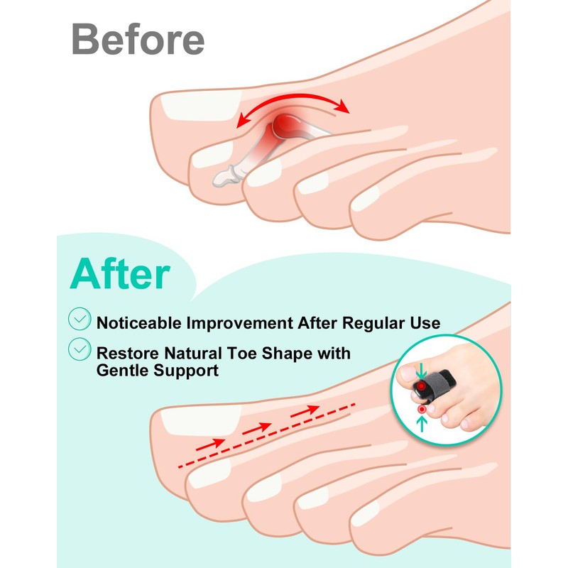snqqmtt 2Pcs Hammer Toe Straightener with Removable Aluminum Plate and