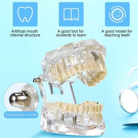 Fahgaer Disease Teeth Model Dental Typodonts Implant Teeth Model with Removable Teeth Dentist Standard Tooth Demonstration