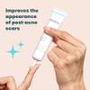 Gel facial para tratamiento de cicatrices de acné