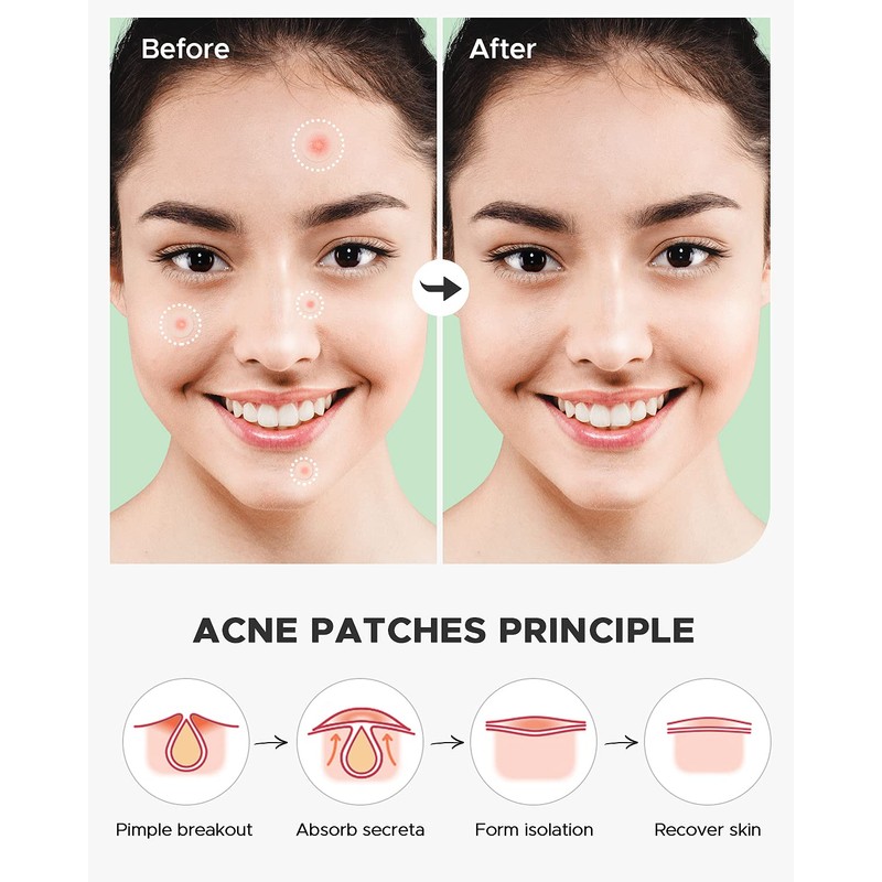 ZATKTK Acne Pimple Patch (180 Counts 4 Sizes), FSA Eligible